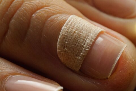 Nagelbettentzündung: Pflaster oder Luft – Was ist die beste Behandlung?
