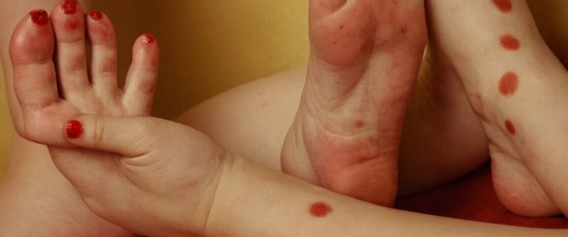 Hand-Mund-Fuß Krankheit: Alles zur Inkubationszeit und Symptomen