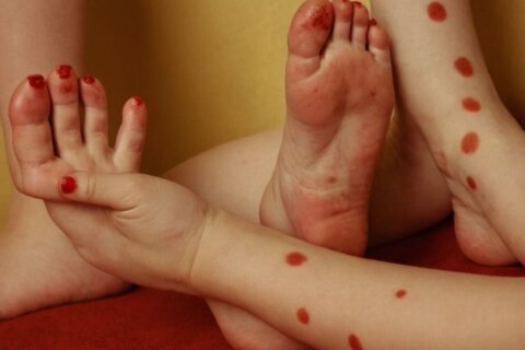Hand-Mund-Fuß Krankheit: Alles zur Inkubationszeit und Symptomen